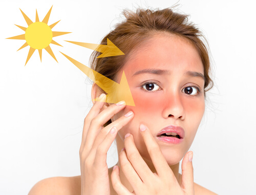 Remedies for Treating Sunburn