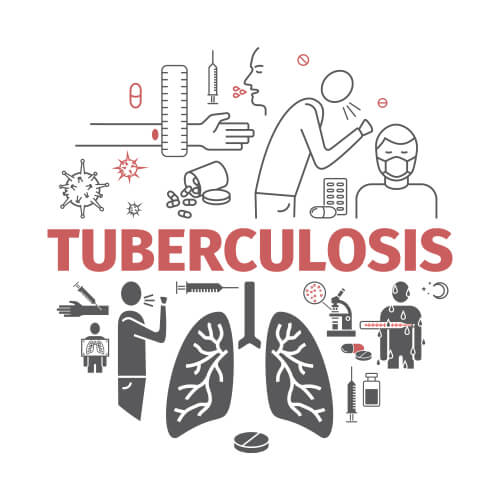 Tuberculosis